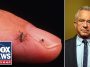HHS SOUNDS ALARM as Lyme disease cases SURGE nationwide